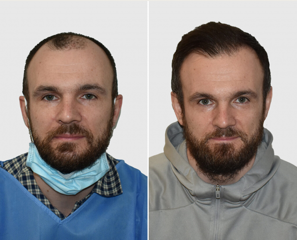 Hair Transplant After 1 Month